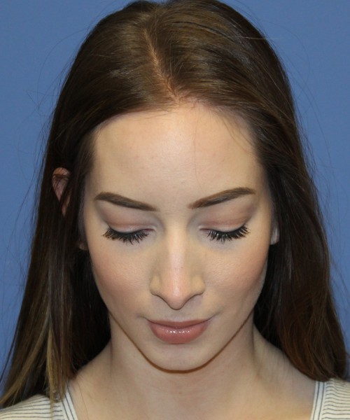 Rhinoplasty, Chin Augmentation 4614 – Click HERE for more views before photo. Individual results may vary.