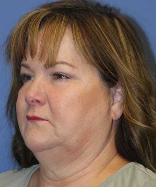 Blepharoplasty (Eyelids) 4630 – Click HERE for more views after photo. Individual results may vary.