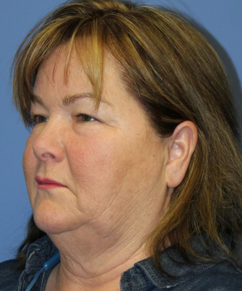Blepharoplasty (Eyelids) 4630 – Click HERE for more views before photo. Individual results may vary.