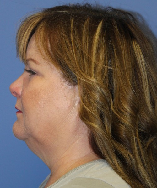 Blepharoplasty (Eyelids) 4630 – Click HERE for more views after photo. Individual results may vary.
