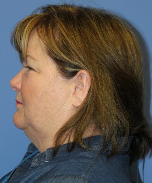 Blepharoplasty (Eyelids) 4630 – Click HERE for more views before photo. Individual results may vary.