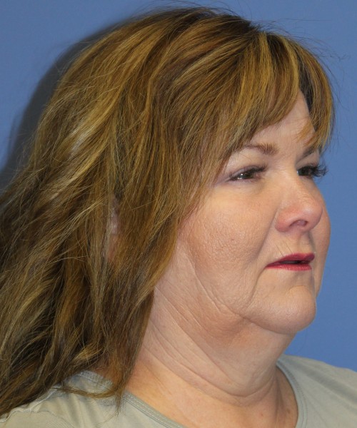 Blepharoplasty (Eyelids) 4630 – Click HERE for more views after photo. Individual results may vary.