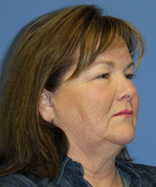 Blepharoplasty (Eyelids) 4630 – Click HERE for more views before photo. Individual results may vary.