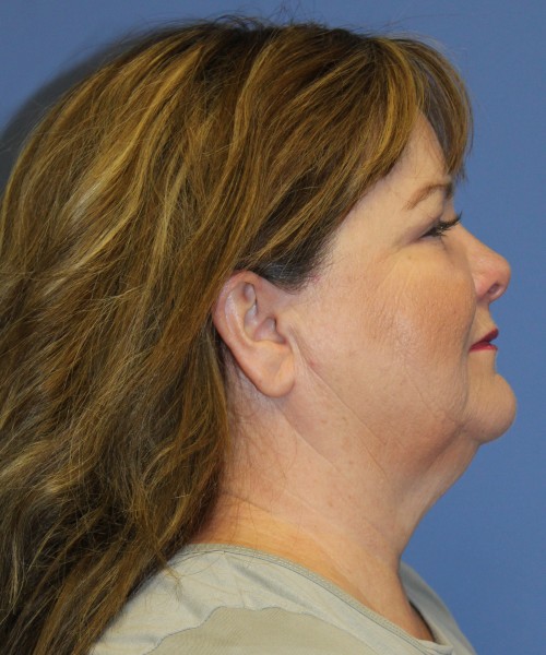 Blepharoplasty (Eyelids) 4630 – Click HERE for more views after photo. Individual results may vary.