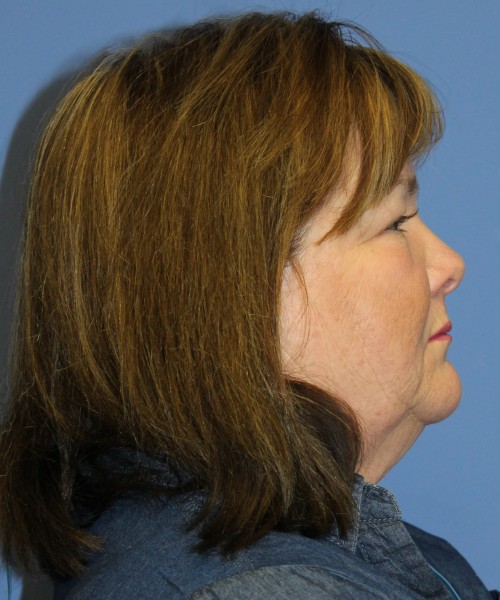 Blepharoplasty (Eyelids) 4630 – Click HERE for more views before photo. Individual results may vary.
