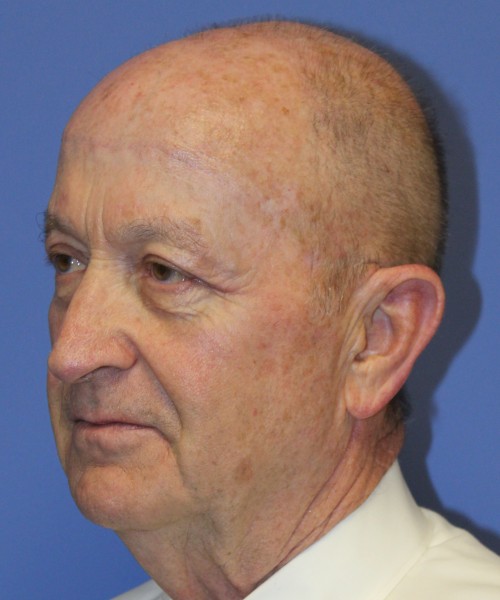 Blepharoplasty (Eyelids), Browlift 4642 – Click HERE for more views after photo. Individual results may vary.