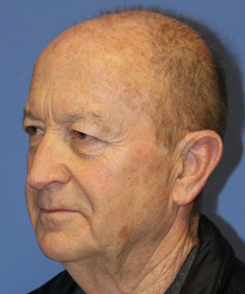 Blepharoplasty (Eyelids), Browlift 4642 – Click HERE for more views before photo. Individual results may vary.