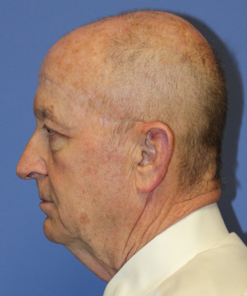 Blepharoplasty (Eyelids), Browlift 4642 – Click HERE for more views after photo. Individual results may vary.