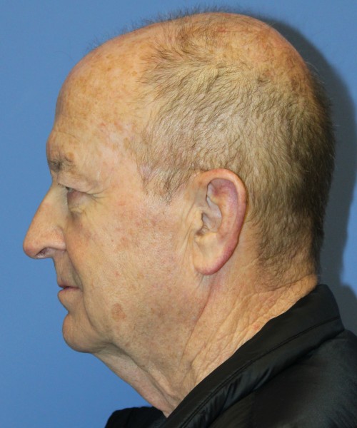 Blepharoplasty (Eyelids), Browlift 4642 – Click HERE for more views before photo. Individual results may vary.