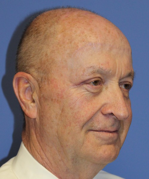 Blepharoplasty (Eyelids), Browlift 4642 – Click HERE for more views after photo. Individual results may vary.