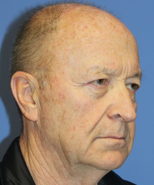 Blepharoplasty (Eyelids), Browlift 4642 – Click HERE for more views before photo. Individual results may vary.