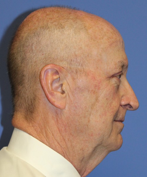 Blepharoplasty (Eyelids), Browlift 4642 – Click HERE for more views after photo. Individual results may vary.