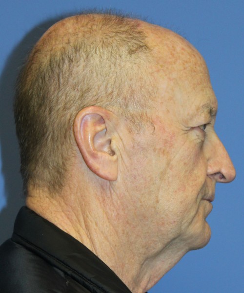 Blepharoplasty (Eyelids), Browlift 4642 – Click HERE for more views before photo. Individual results may vary.