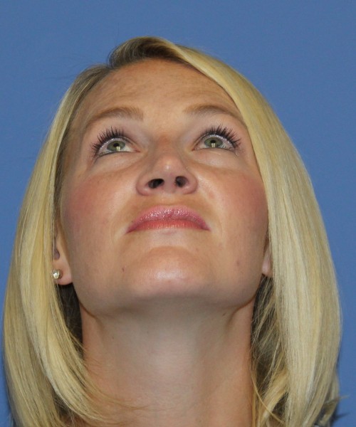 Rhinoplasty 4655 – Click HERE for more photos after photo. Individual results may vary.