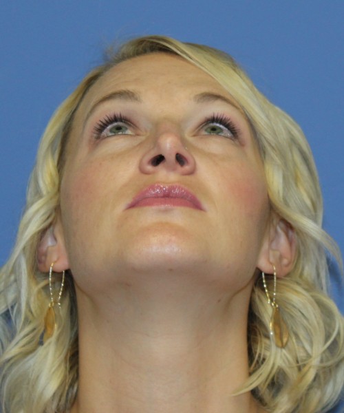 Rhinoplasty 4655 – Click HERE for more photos before photo. Individual results may vary.