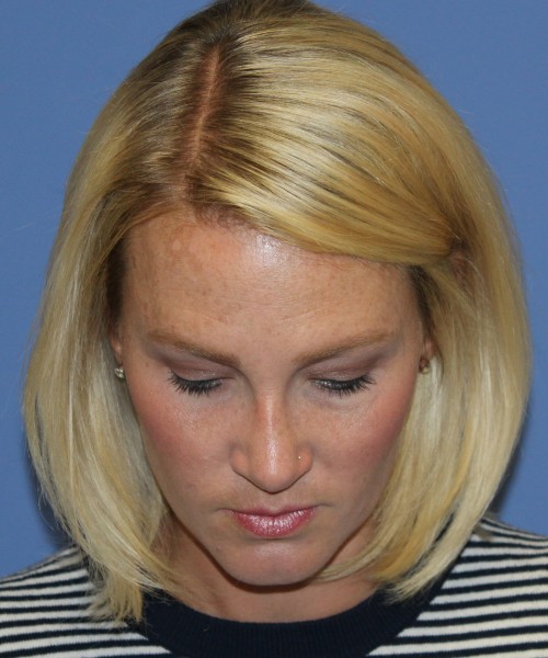 Rhinoplasty 4655 – Click HERE for more photos after photo. Individual results may vary.