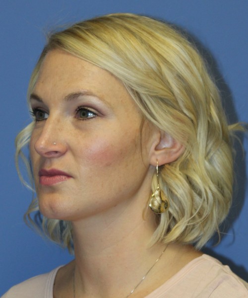 Rhinoplasty 4655 – Click HERE for more photos before photo. Individual results may vary.