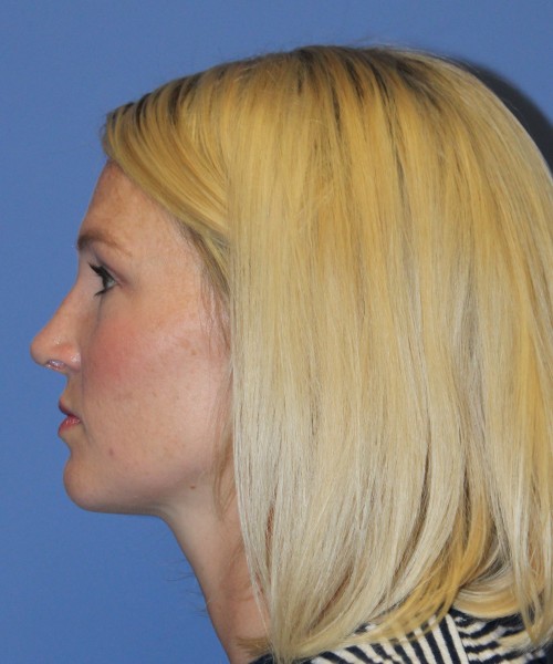 Rhinoplasty 4655 – Click HERE for more photos after photo. Individual results may vary.