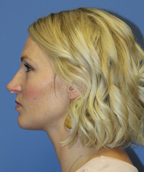 Rhinoplasty 4655 – Click HERE for more photos before photo. Individual results may vary.