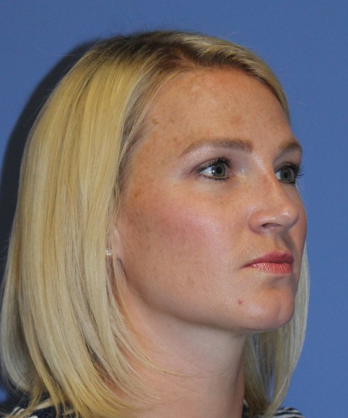 Rhinoplasty 4655 – Click HERE for more photos after photo. Individual results may vary.
