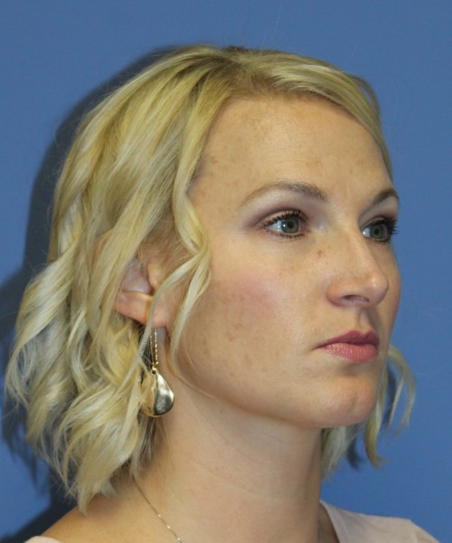 Rhinoplasty 4655 – Click HERE for more photos before photo. Individual results may vary.