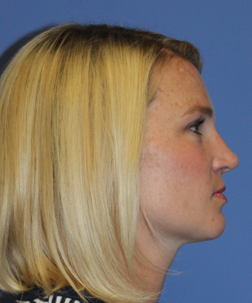 Rhinoplasty 4655 – Click HERE for more photos after photo. Individual results may vary.