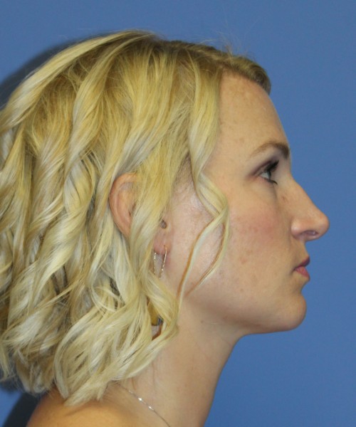 Rhinoplasty 4655 – Click HERE for more photos before photo. Individual results may vary.