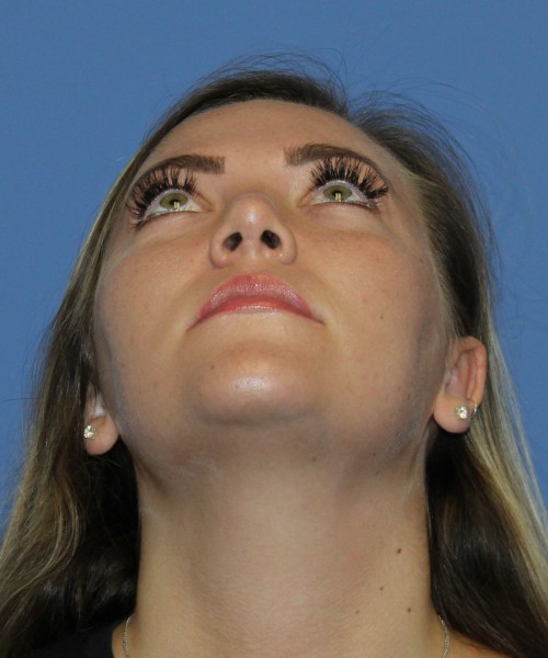 Rhinoplasty 4670 – Click HERE for more photos after photo. Individual results may vary.