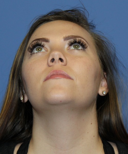 Rhinoplasty 4670 – Click HERE for more photos before photo. Individual results may vary.