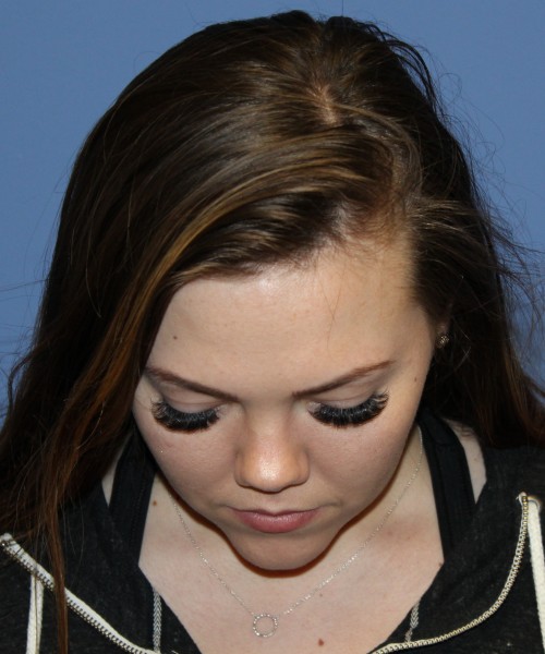 Rhinoplasty 4670 – Click HERE for more photos before photo. Individual results may vary.