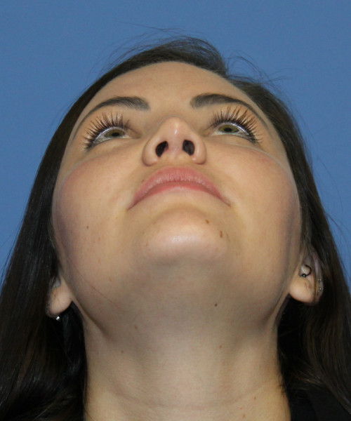 Rhinoplasty 4685 – Click HERE for more photos after photo. Individual results may vary.