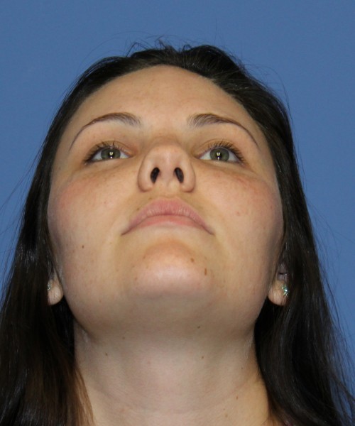 Rhinoplasty 4685 – Click HERE for more photos before photo. Individual results may vary.