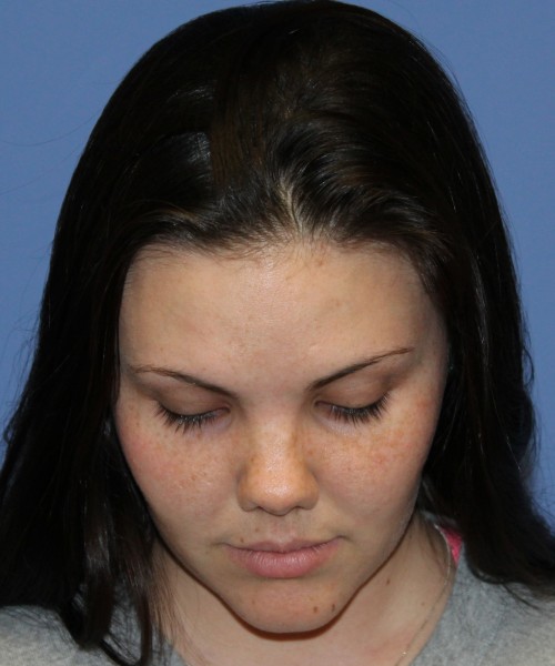 Rhinoplasty 4685 – Click HERE for more photos before photo. Individual results may vary.