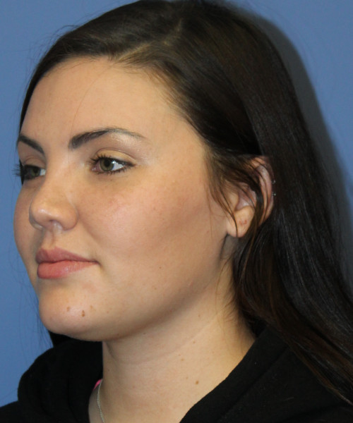 Rhinoplasty 4685 – Click HERE for more photos after photo. Individual results may vary.