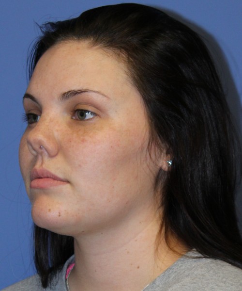 Rhinoplasty 4685 – Click HERE for more photos before photo. Individual results may vary.