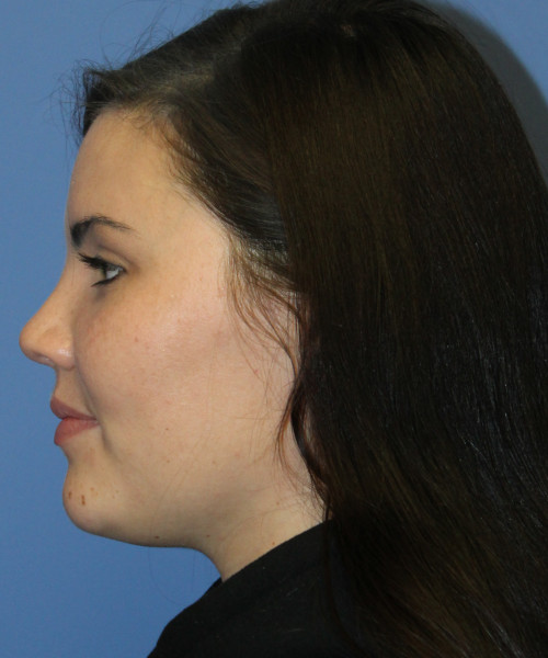 Rhinoplasty 4685 – Click HERE for more photos after photo. Individual results may vary.