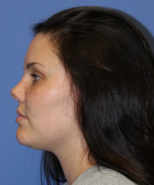Rhinoplasty 4685 – Click HERE for more photos before photo. Individual results may vary.