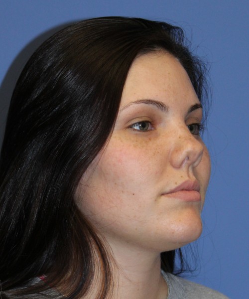 Rhinoplasty 4685 – Click HERE for more photos before photo. Individual results may vary.
