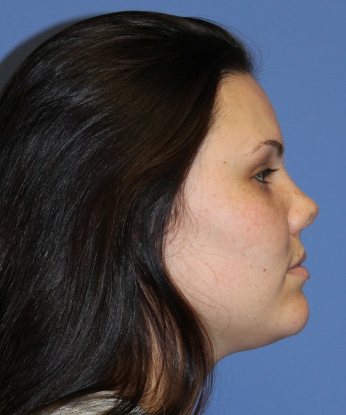 Rhinoplasty 4685 – Click HERE for more photos before photo. Individual results may vary.