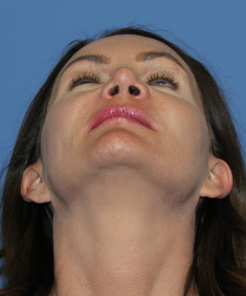 Revision Rhinoplasty 4701 – Click HERE for more photos after photo. Individual results may vary.