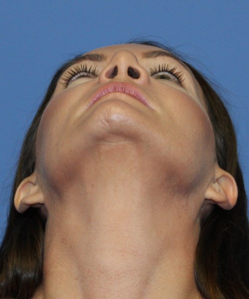 Revision Rhinoplasty 4701 – Click HERE for more photos before photo. Individual results may vary.