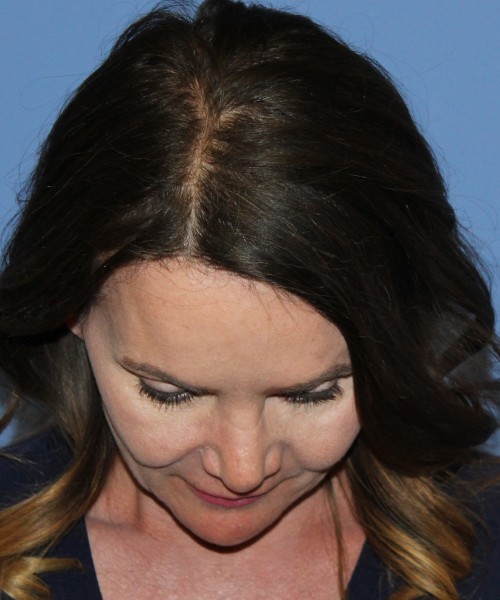 Revision Rhinoplasty 4701 – Click HERE for more photos after photo. Individual results may vary.
