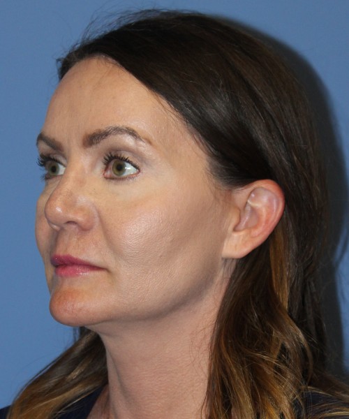 Revision Rhinoplasty 4701 – Click HERE for more photos after photo. Individual results may vary.