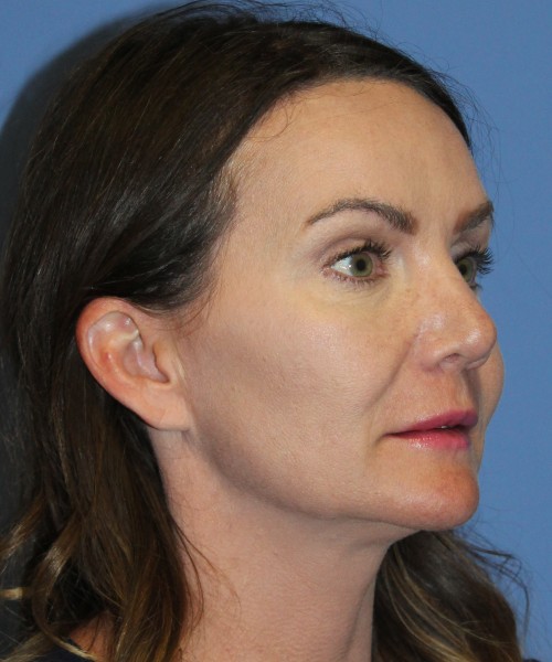 Revision Rhinoplasty 4701 – Click HERE for more photos after photo. Individual results may vary.