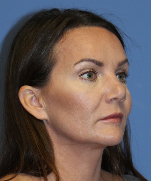 Revision Rhinoplasty 4701 – Click HERE for more photos before photo. Individual results may vary.