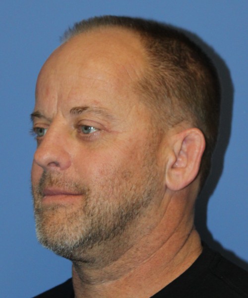 Blepharoplasty (eyelids), Facial Fat Grafting 4728 – Click HERE for more views after photo. Individual results may vary.