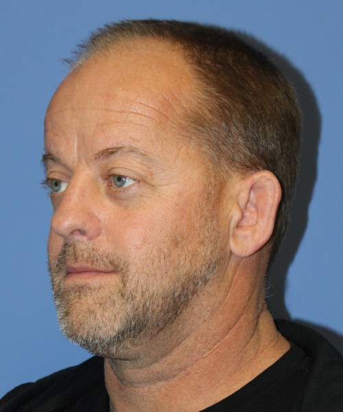 Blepharoplasty (eyelids), Facial Fat Grafting 4728 – Click HERE for more views before photo. Individual results may vary.