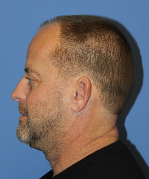 Blepharoplasty (eyelids), Facial Fat Grafting 4728 – Click HERE for more views after photo. Individual results may vary.