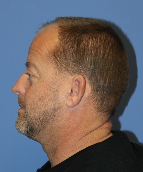 Blepharoplasty (eyelids), Facial Fat Grafting 4728 – Click HERE for more views before photo. Individual results may vary.