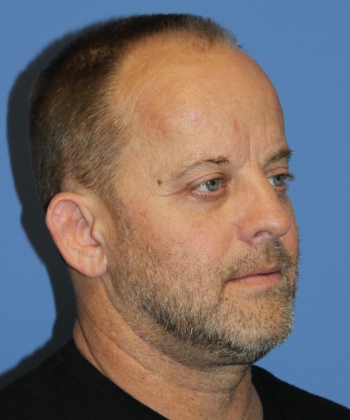 Blepharoplasty (eyelids), Facial Fat Grafting 4728 – Click HERE for more views after photo. Individual results may vary.